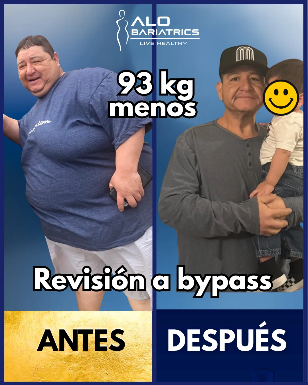 Bariatric surgery before and after — patient 56