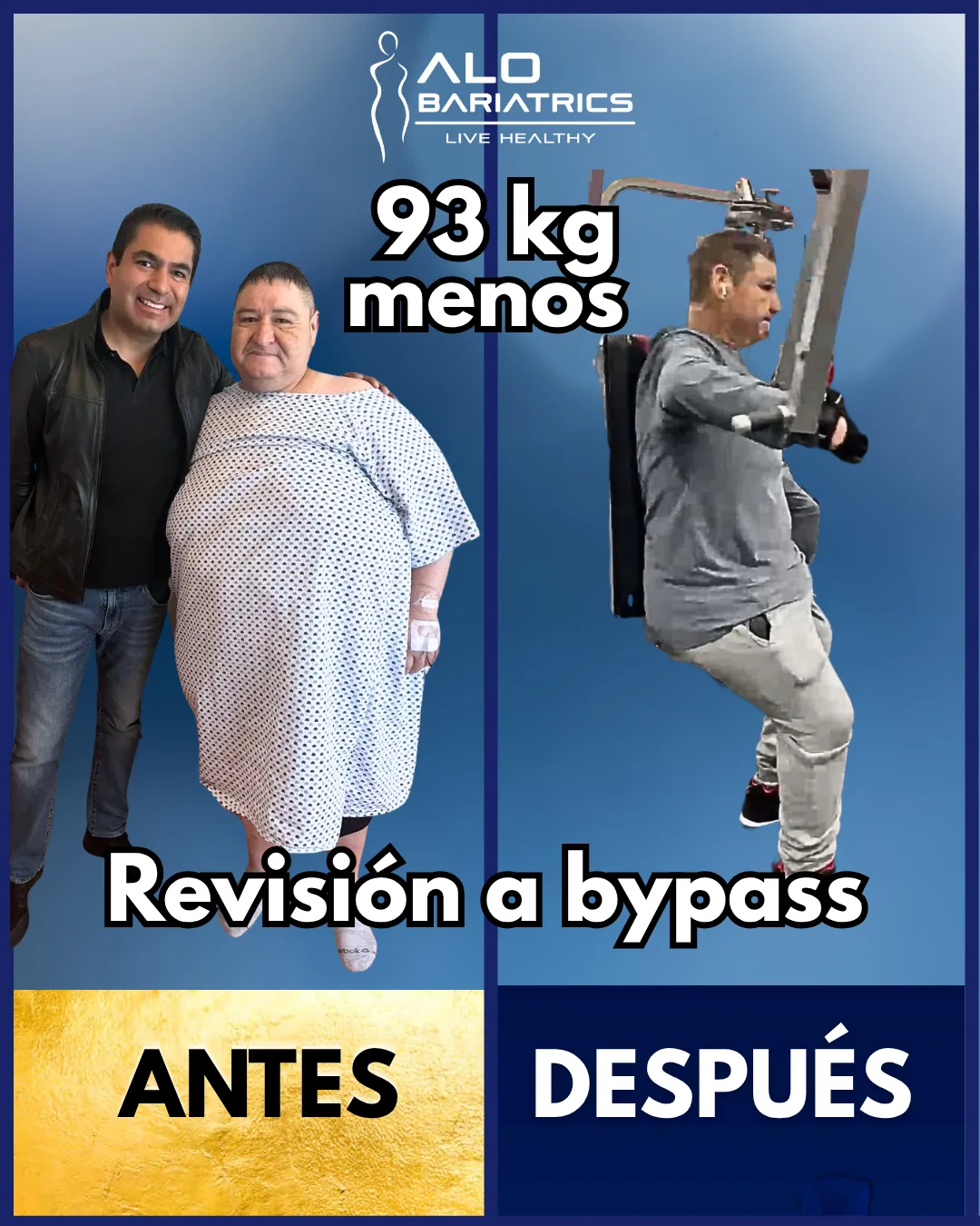Bariatric surgery before and after — patient 57