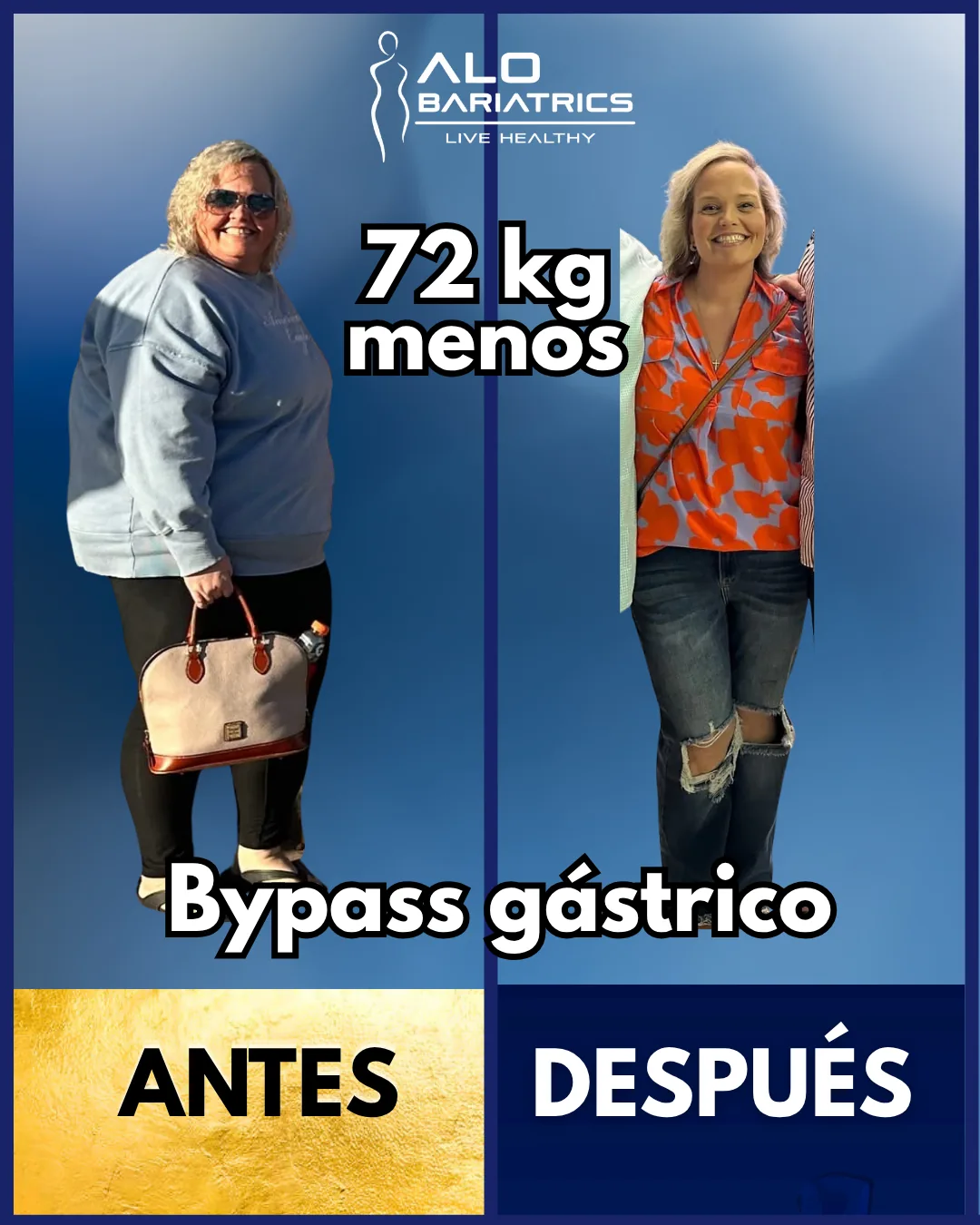Bariatric surgery before and after — patient 58