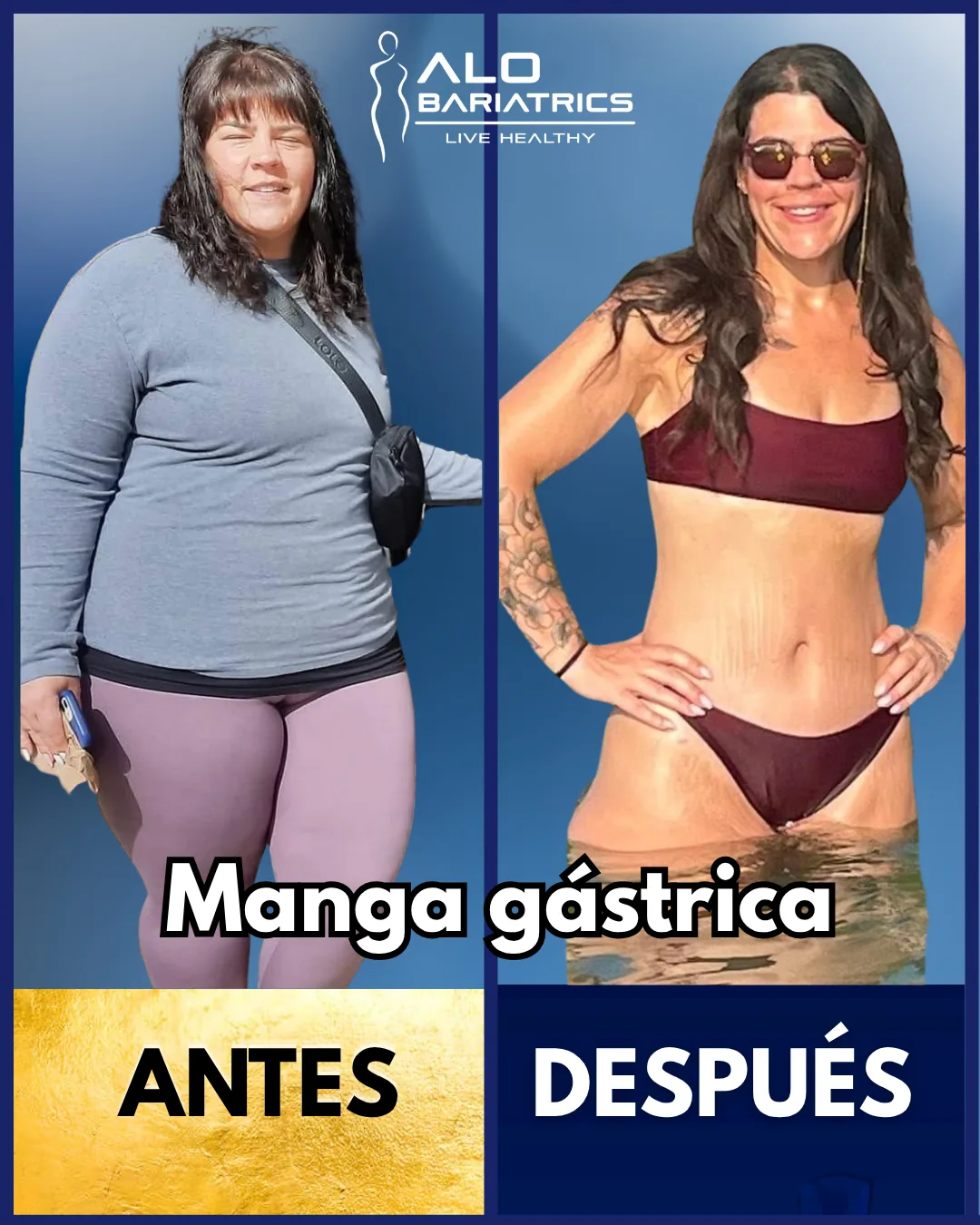 Bariatric surgery before and after — patient 59