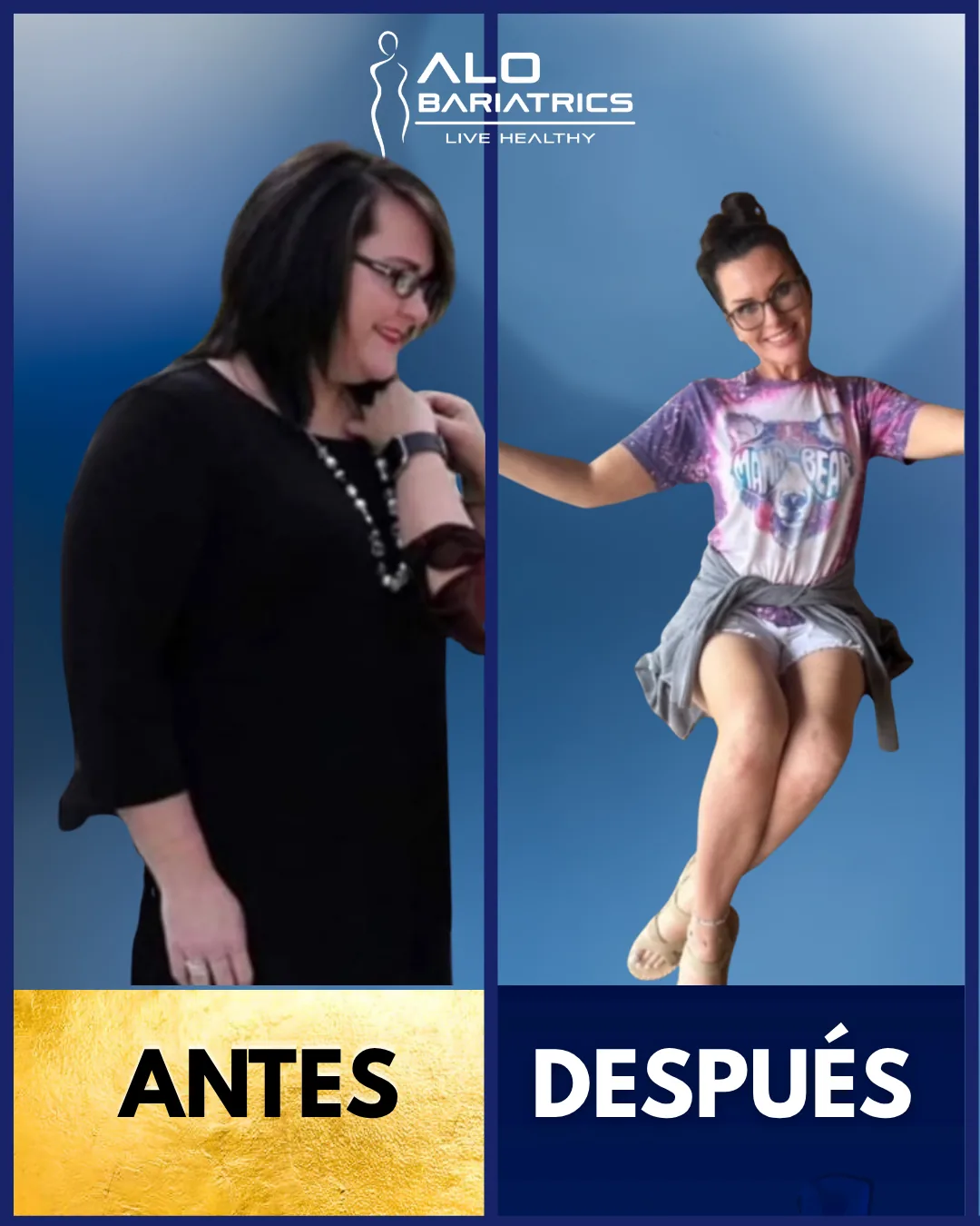 Bariatric surgery before and after — patient 6
