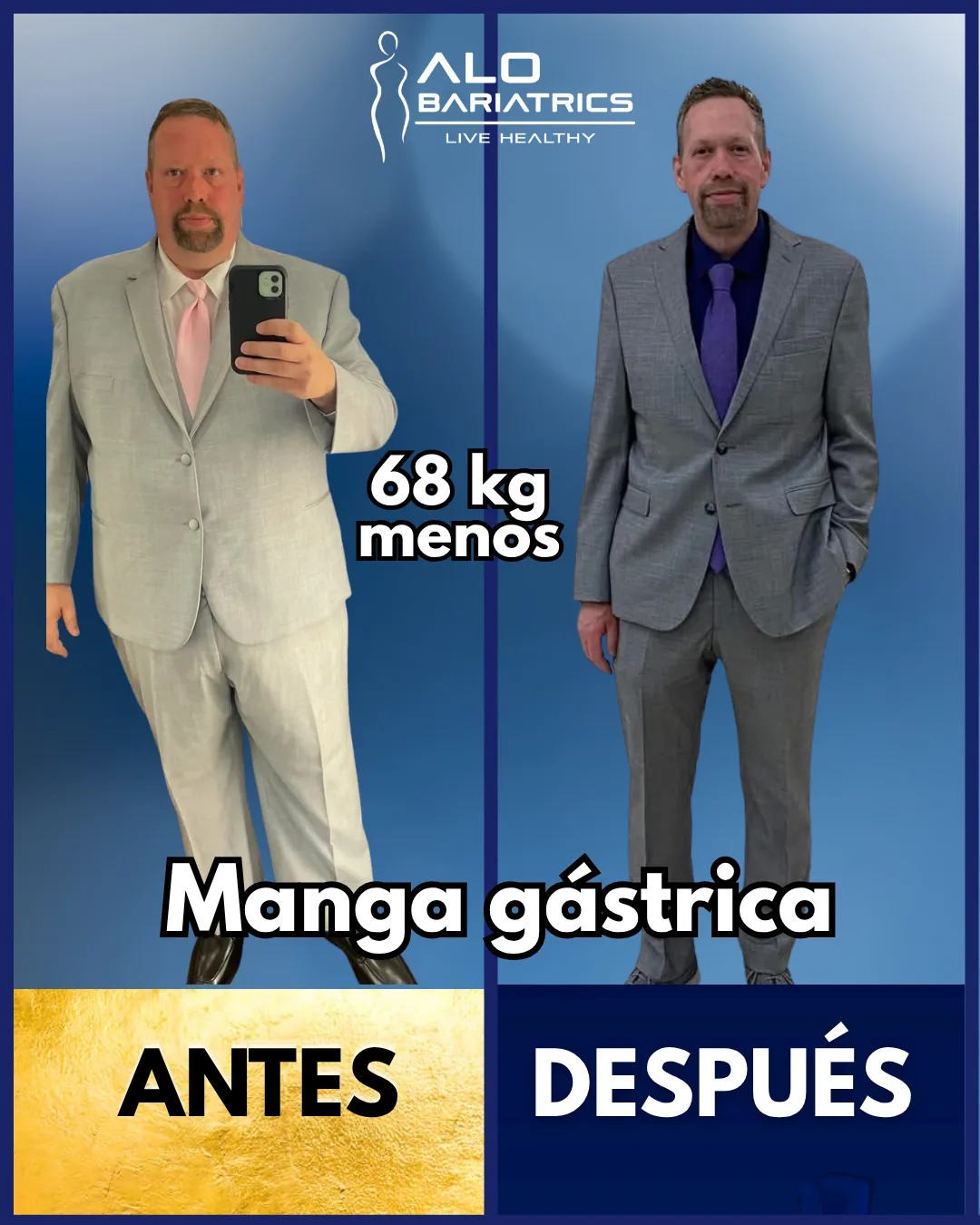 Bariatric surgery before and after — patient 61