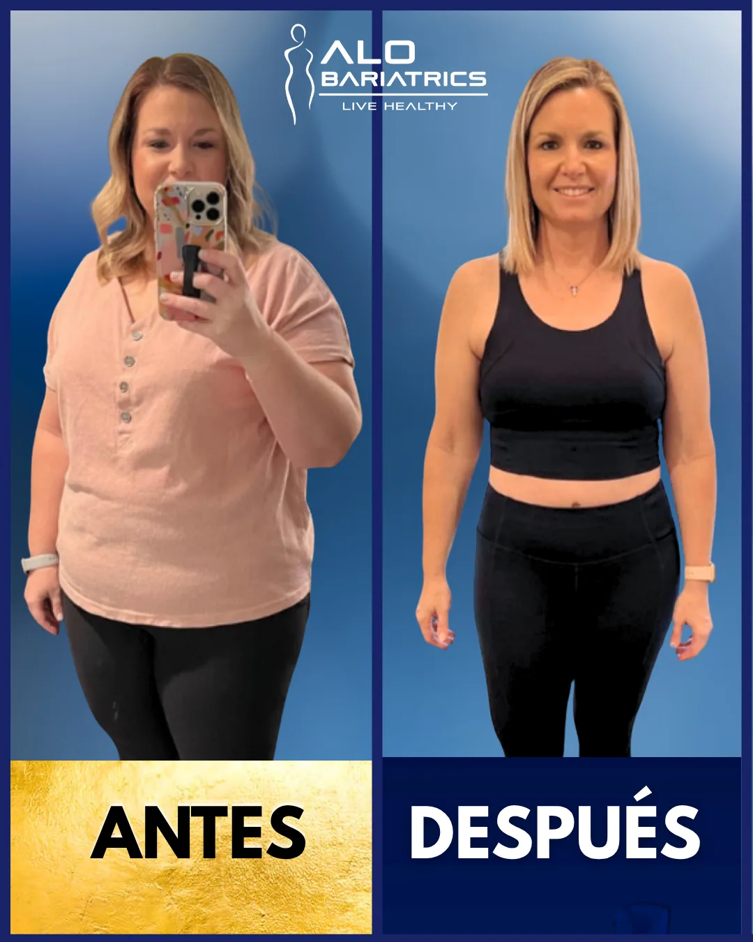 Bariatric surgery before and after — patient 9