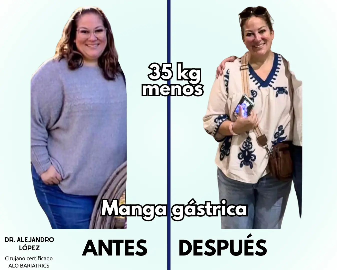 Antes y despues de manga gástrica con el Dr. Alejandro López