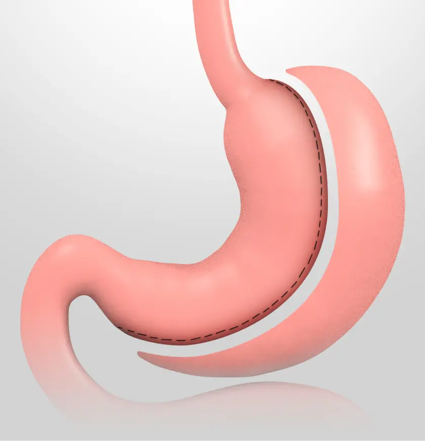 Qué es la manga gástrica - gastrectomía en manga