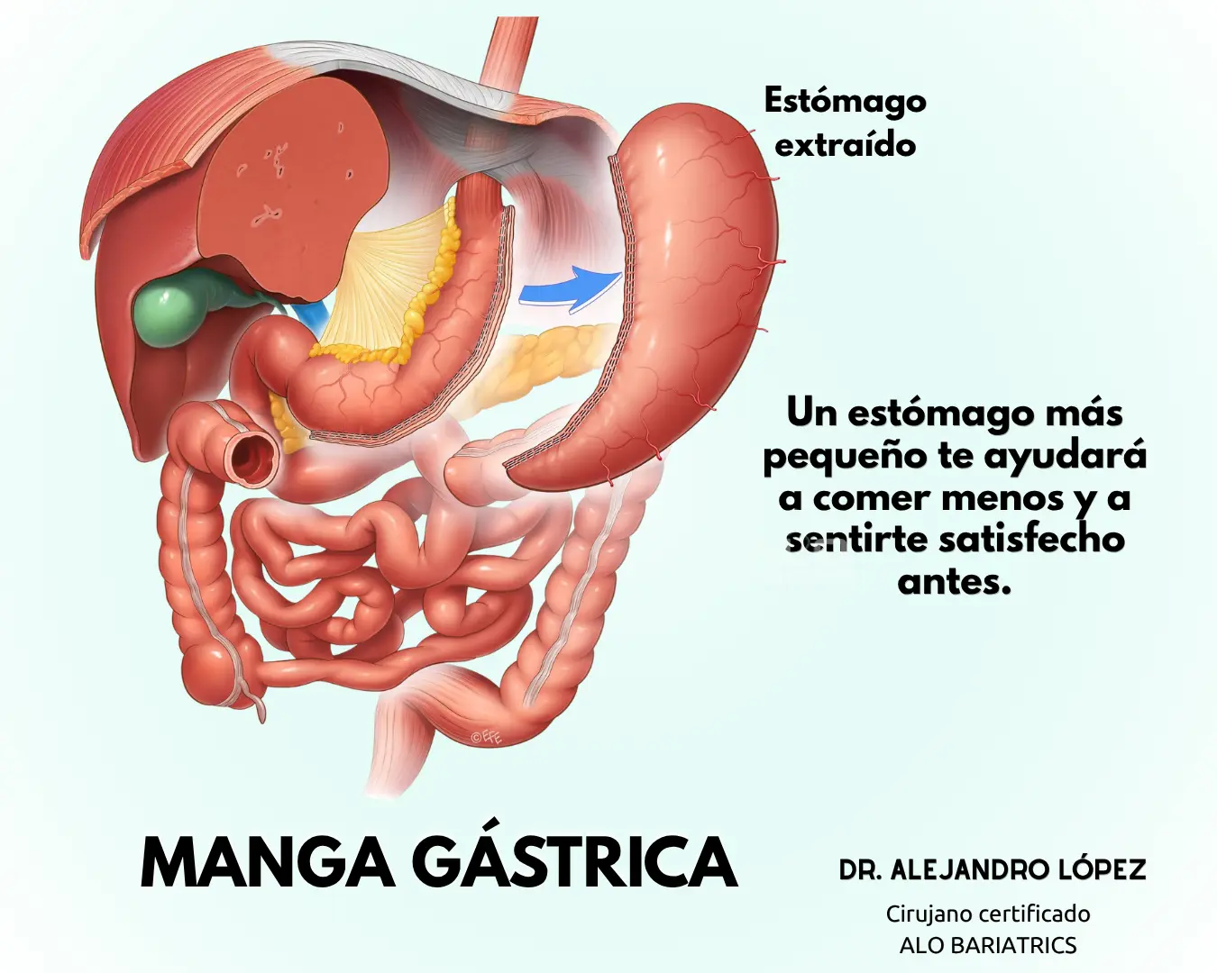 Manga gástrica en Guadalajara