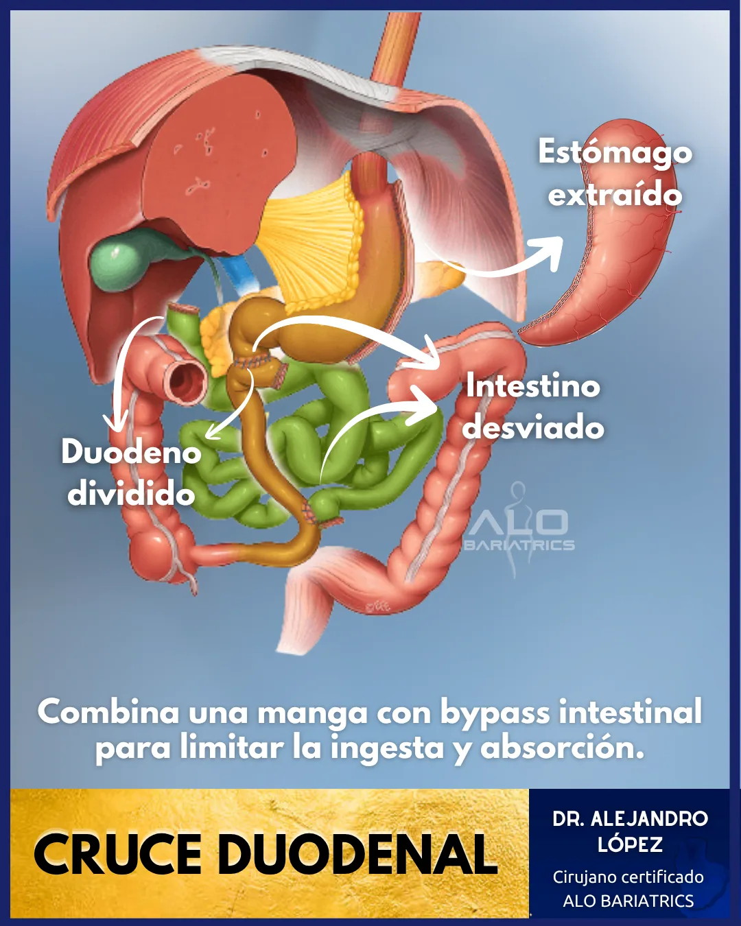 Duodenal switch anatomical diagram