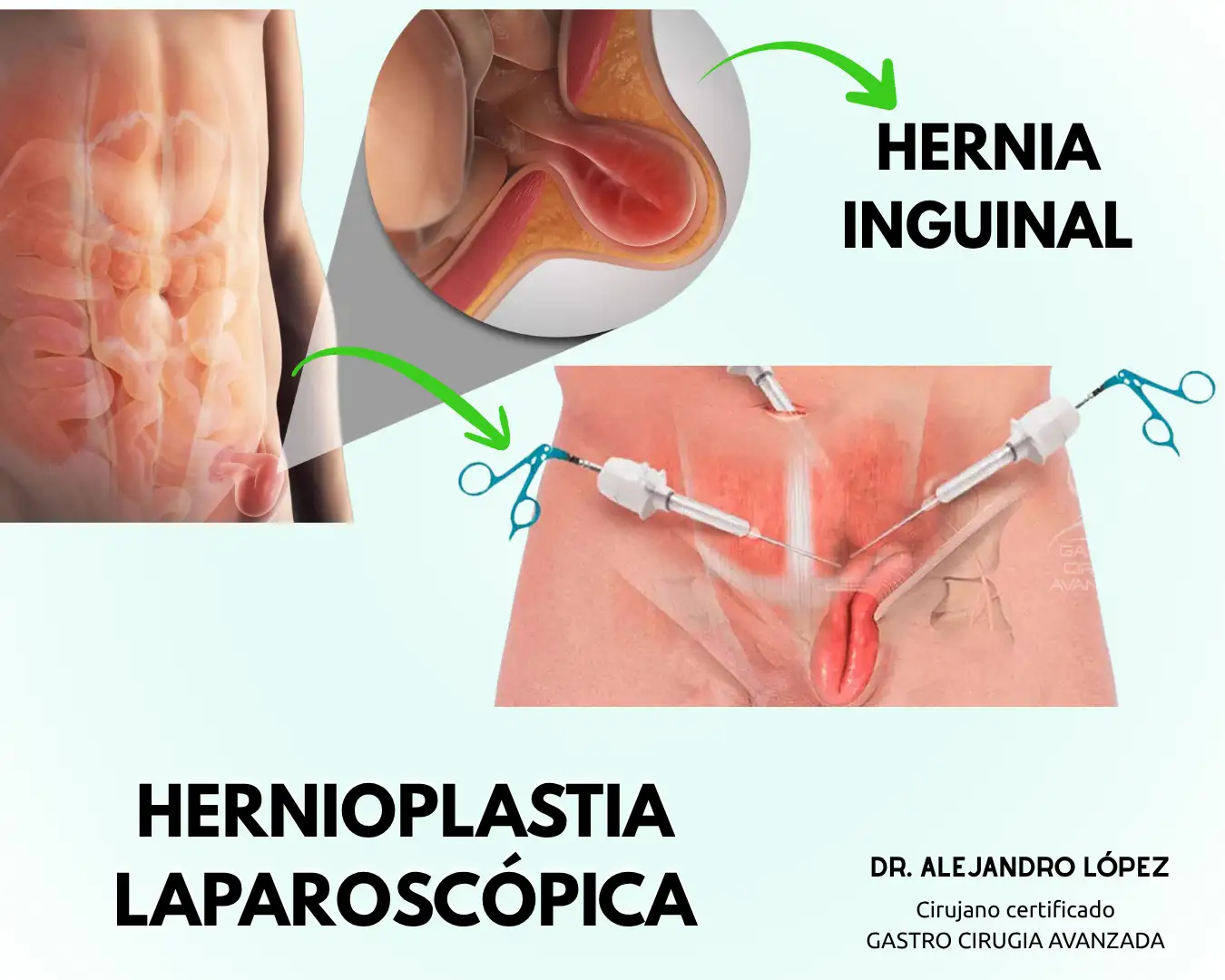 Inguinal hernia laparoscopic surgery in Guadalajara