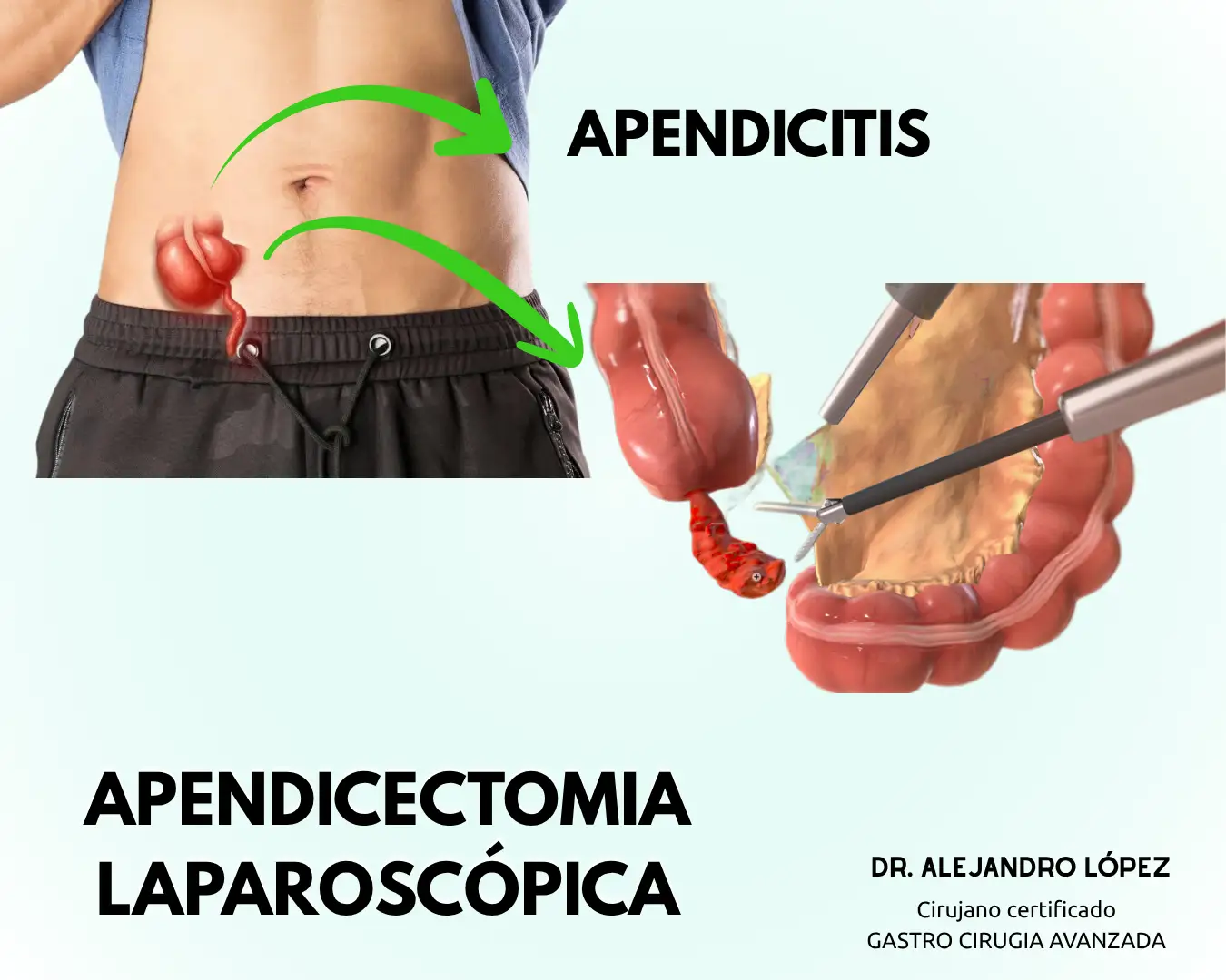 Laparoscopic appendectomy in Guadalajara