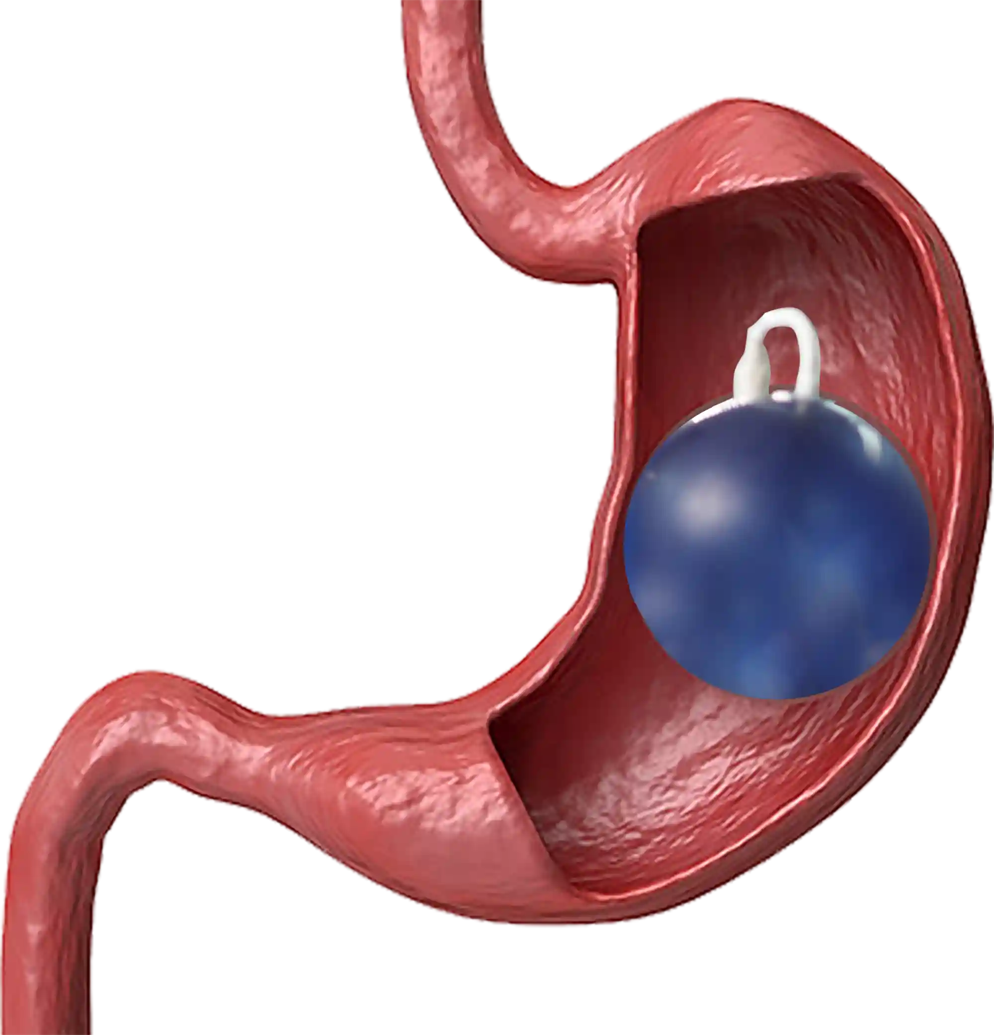 SPATZ gastric balloon in Guadalajara - non-surgical weight loss