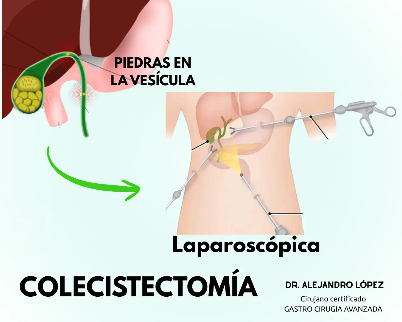 Laparoscopic gallbladder surgery in Guadalajara