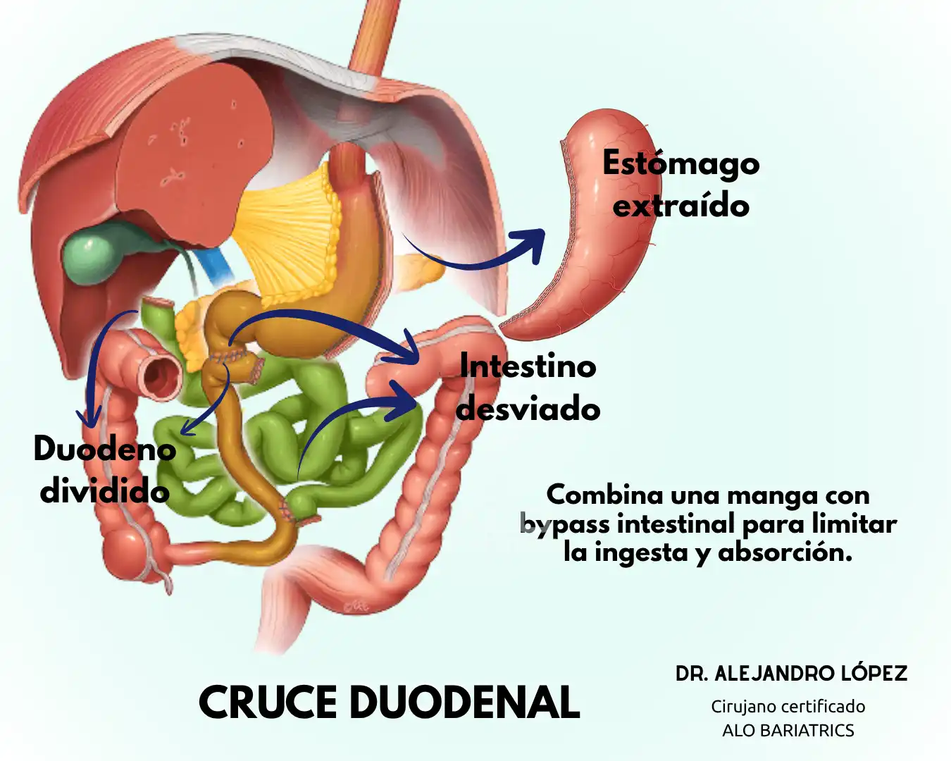 Duodenal switch surgery in Guadalajara with Dr. Alejandro López