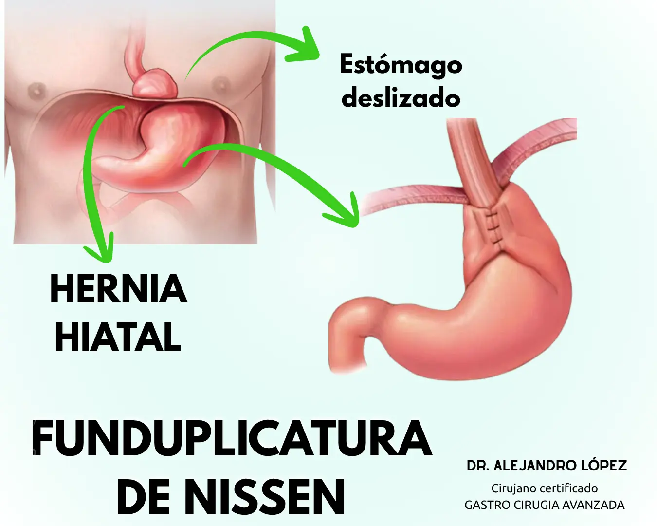 Funduplicatura laparoscópica - Cirugía de hernia hiatal