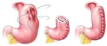 Procedimiento plicatura gástrica